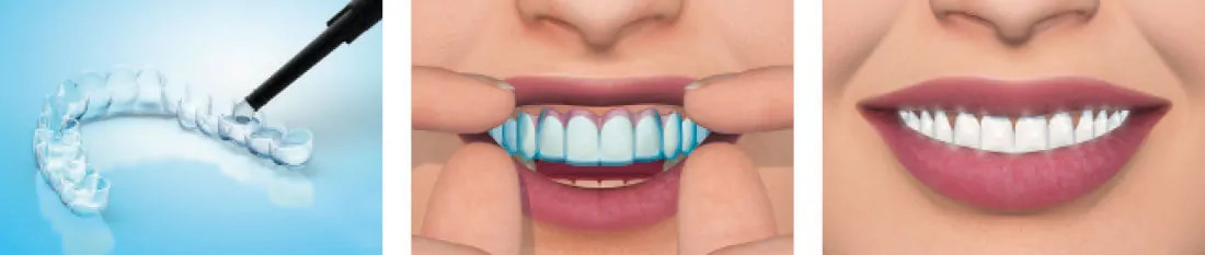 Home Whitening